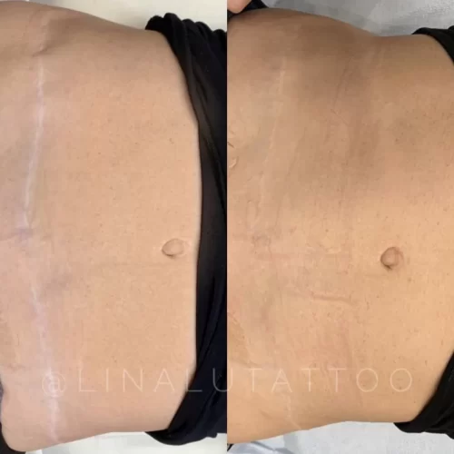 Scar Camouflage Tattoo Vancouver DAELA Shonna