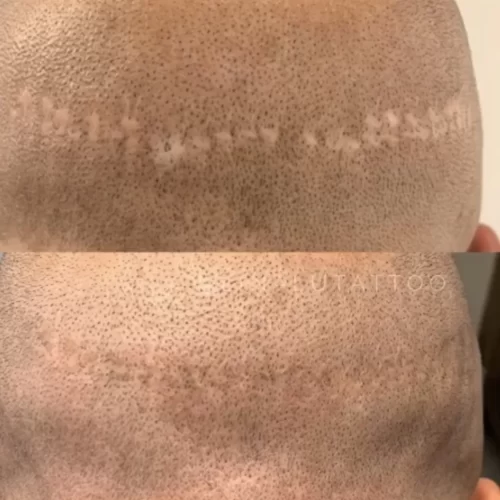 FUE and FUT scar camouflage tattoo DAELA Cosmetic Tattoo
